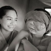 Pooh menderita retinoblastoma, bentuk kanker langka yang dimulai di retina, bagian dari mata yang bertanggung jawab untuk deteksi cahaya. Foto: Dok. Facebook Atittaya Chumkeaw