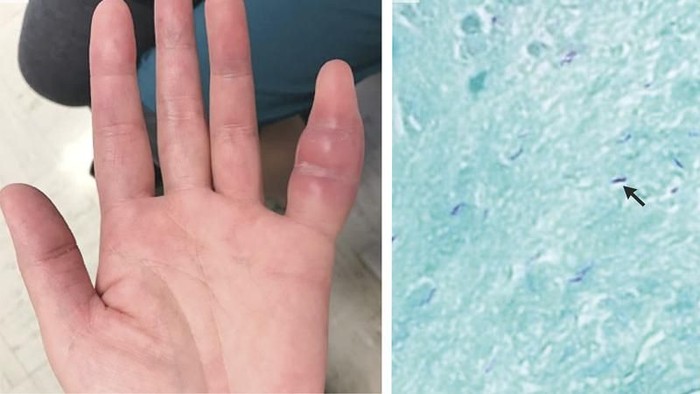 Foto penampakan jari kelingking yang bengkak dan hasil dari pengamatan jaringan lunak. Foto: The New England Journal of Medicine Foto penampakan jari kelingking yang bengkak dan hasil dari pengamatan jaringan lunak. Foto: The New England Journal of Medicine