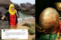 Kista 12 Kg yang diangkat dari rahim Nur Ezzati.