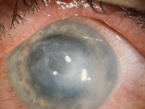 Muncul Wabah Infeksi Mata Langka di Antara Pengguna Softlens