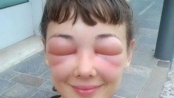 Bekerja di peternakan lebah, belakangan diketahui gadis ini alergi lebah. Foto: boredpanda