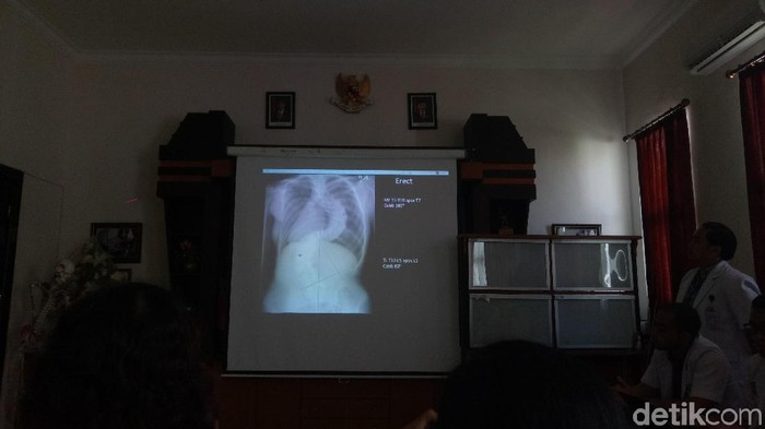Kelengkungan tulang belakang yang dialami Febi mencapai 100 derajat hingga menyentuh paru-paru. (Foto: Aditya Mardiastuti/detikHealth) Kelengkungan tulang belakang yang dialami Febi mencapai 100 derajat hingga menyentuh paru-paru. (Foto: Aditya Mardiastuti/detikHealth)