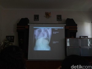 Bahagianya Febi Lepas dari Derita Punggung Melengkung 100 Derajat