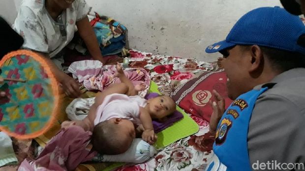Meisya dan Meikha, bayi kembar siam di Gunungkidul.