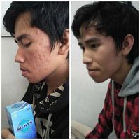 Obat Jerawat Ini Bergaransi 100%, Uang Kembali Jika Tak Sembuh