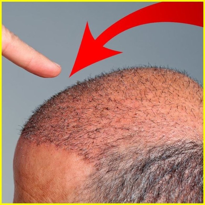 Peneliti Terkejut, Ada Metode yang Cepat Menumbuhkan Rambut