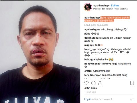 Habis 'Operasi Plastik', Agan Harahap Juga Bonyok