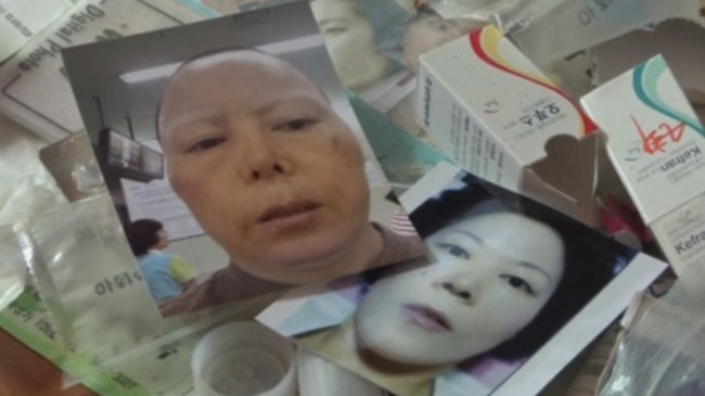 Kim tertarik melakoni operasi plastik karena tidak menyukai bentuk hidungnya. Dan dia semakin terobsesi operasi hidung karena ada kepercayaan di Korea bahwa mereka yang memiliki bentuk hidung mancung dengan bagian ujungnya mencuat ke atas sulit untuk menjadi kaya. Foto: REUTERS/Kim Hong-Ji