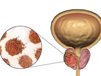Mengenal Kanker Prostat, Dari Penyebab, Gejala, Dan Cara Mencegahnya ...