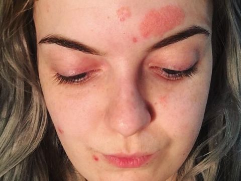 Kisah Wanita Pamer Foto dengan Ruam Wajah Demi Dapatkan Cinta Sejati