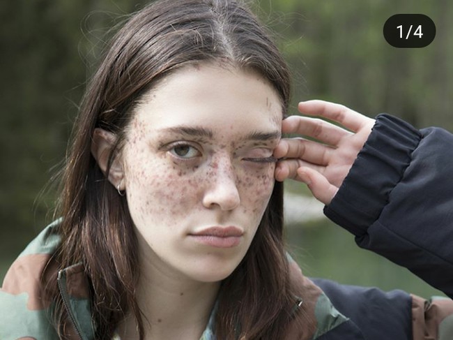 Freckles-freckles di wajahnya tersebut akibat masalah ginjal di masa lalu. Masalah tersebut berpengaruh juga pada kulit Maeva yang merangsang hiperpigmentasi. Kemudian timbul bintik hitam di pipi hinga bagian matanya. Foto: Instagram (@maevamarshall)