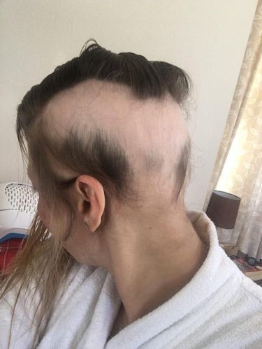 Wanita Ini Alami Hal Mengerikan karena Stres Menyiapkan Pesta Pernikahan