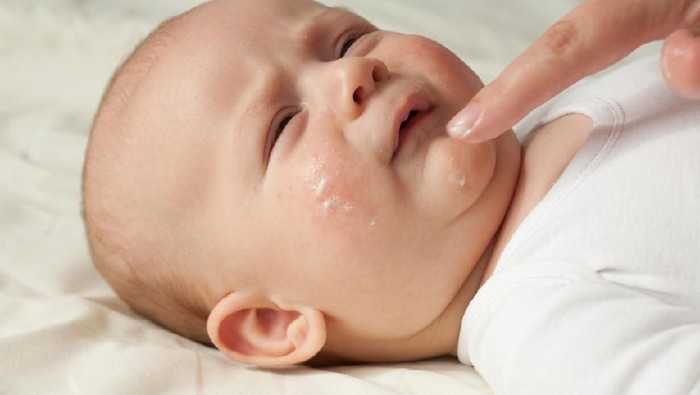 Ilustrasi ibu dan bayi terusir dari pesawat karena kondisi kulit yang memerah dan mengelupas. Foto: iStock Ilustrasi ibu dan bayi terusir dari pesawat karena kondisi kulit yang memerah dan mengelupas. Foto: iStock