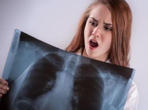 Implan KB di Lengan Menghilang, Tahu-tahu Ada di Paru