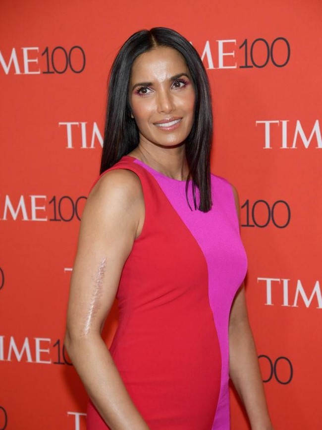 Celebrity chef Padma Lakshmi punya bekas luka di lengannya, akibat kecelakaan mobil ketika usianya 14 tahun. Ia pun tak malu memperlihatkan bekas luka dengan memakai busana strapless maupun sleeveless. Tubuhku adalah jejak dari kehidupanku, dari setiap tragedi emosional ataupun fisik. Aku mencintai bekas lukaku, kata Padma, seperti dikutip dari Revelist. Foto: Getty Images