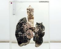 Paru-paru perokok berat (dok. NIMHANS)