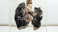 Selain otak manusia, ada juga organ-organ tubuh lainnya. Ini contohnya adalah paru-paru seorang perokok berat, dan masih banyak lagi yang lainnya. (NIMHANS)