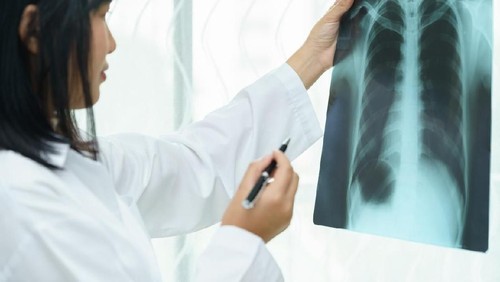 Young woman got nose allergy, flu sneezing nose