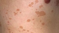 Bercak-bercak panu punya ciri khas biasanya berbentuk oval sebelum meluas. Foto: Primary Care Dermatology Society/Dermatoweb