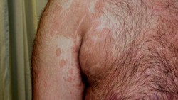Munculnya bercak putih di kulit bisa disebabkan banyak hal. Lalu bagaimana kita bisa tahu terinfeksi panu? Ada beberapa ciri khas yang bisa diperhatikan.