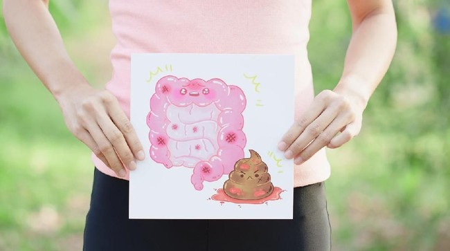 Jadi Penyebab Istri Ustad Maulana Meninggal, Ini 4 Fakta Kanker Usus