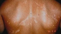 Pada kasus orang dengan kulit cenderung hitam panu muncul sebagai bercak putih. Foto: Primary Care Dermatology Society/Dermatoweb