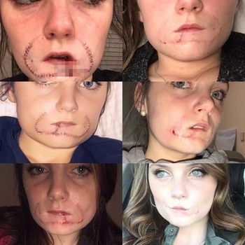 Menolak Cium Mantan, Bibir Wanita Ini Digigit Hingga Hampir Lepas