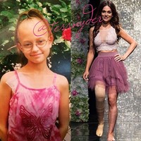 Butuh 20 tahun baginya untuk bisa menerima kaki palsunya sekarang. Ada kalanya ia sangat frustasi dengan penampilannya yang hanya memiliki satu kaki. Baru ketika berusia 30 tahun aku justru merasa cantik dan seksi lebih dari sebelumnya. Foto: Instagram @tessnyder
