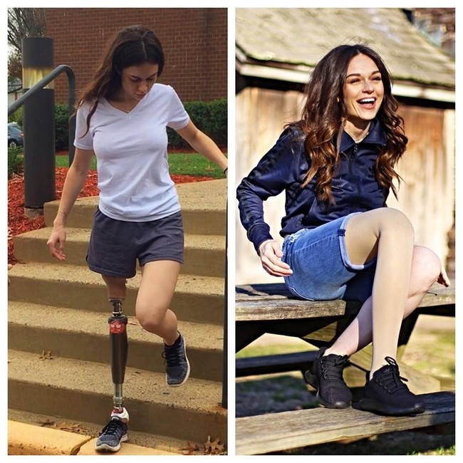 Berbagai media pernah memberitakan ibu dua anak ini. Ia bahkan tampil di televisi, seperti Fox. Kaki prostetik ini adalah bagian dariku, dan itulah diriku, ujarnya. Foto: Instagram @tessnyder