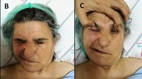 Biasanya kelumpuhan stroke dialami di bagian wajah bagian bawah. Namun kadang satu sisi wajah, termasuk mata, juga bisa terpengaruh seperti dialami pasien wanita ini. (Foto: HalilOnder/Turkish Journal of Emergency Medicine)
