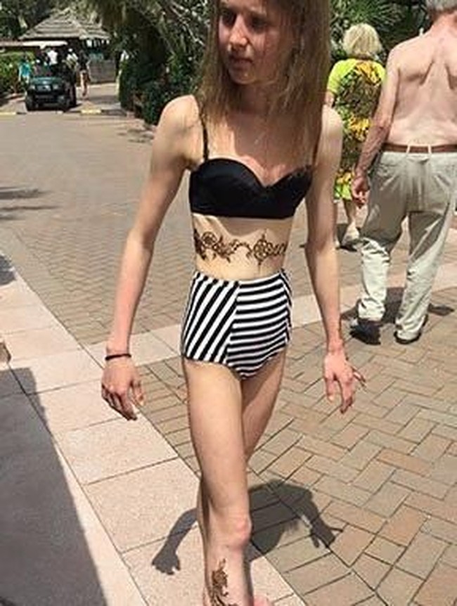 Emily mulai terobsesi dengan olahraga dan melewatkan makan. Ia menjelaskan bagaimana ia tetap memaksakan untuk olahraga meskipun kekurangan asupan kalori. Foto: Instagram