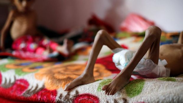 Kondisi anak-anak di Yaman.