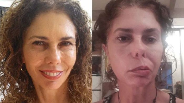 Wajah Perempuan Ini Lumpuh Sebelah Akibat Kutu di Telinga