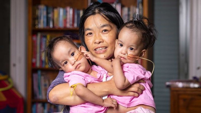 Kembar Siam Asal Bhutan Siap Dioperasi di Melbourne Kembar Siam Asal Bhutan Siap Dioperasi di Melbourne