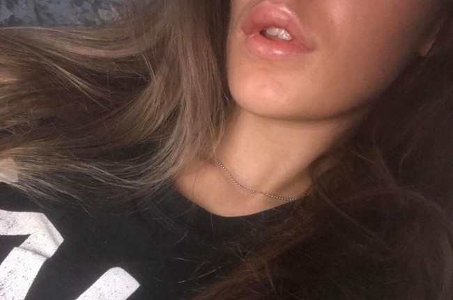 Pengalaman mengerikan setelah filler dialami wanita cantik asal Inggris. Alih-alih mendapatkan bibir tebal seksi, malah jadi kaku seperti beton. Beth Craigs yang suntik filler di sebuah salon di Newcastle, mengaku bibirnya sangat sakit dan bengkak hingga ke bagian rahang setelah filler. Lama-kelamaan bibirnya menjadi keras dan kaku hingga tak bisa digerakkan. Ia pun meminta bantuan dokter yang kemudian menyuntikkan cairan untuk melunakkannya, dan akhirnya kembali normal. Foto: dok. Facebook (Beth Craigs)