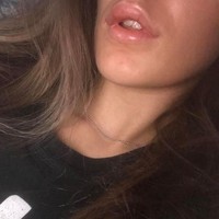 Pengalaman mengerikan setelah filler dialami wanita cantik asal Inggris. Alih-alih mendapatkan bibir tebal seksi, malah jadi kaku seperti beton. Beth Craigs yang suntik filler di sebuah salon di Newcastle, mengaku bibirnya sangat sakit dan bengkak hingga ke bagian rahang setelah filler. Lama-kelamaan bibirnya menjadi keras dan kaku hingga tak bisa digerakkan. Ia pun meminta bantuan dokter yang kemudian menyuntikkan cairan untuk melunakkannya, dan akhirnya kembali normal. Foto: dok. Facebook (Beth Craigs)