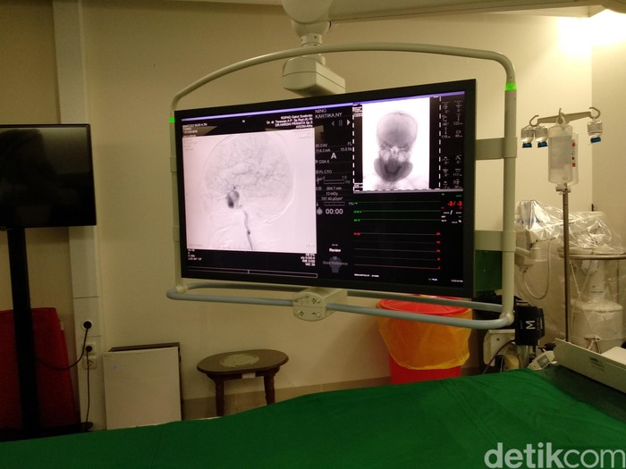 Digital Substraction Angiography cuci otak dr terawan Digital Substraction Angiography cuci otak dr terawan