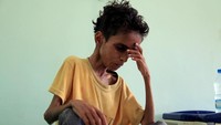 Yaman porak poranda tak hanya akibat perang tetapi juga beragam dampak negatif dari perang tersebut, salah satunya adalah gizi buruk dan kelaparan yang menghantui anak-anak di Yaman. Anees Mahyoub/Reuters.