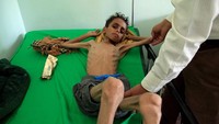 Dalam kunjungannya ke Yaman, Direktur Eksekutif Program Pangan Dunia (WFP), David Beasley, mengeluarkan peringatan bahwa negara itu terancam bencana kemanusiaan terburuk di dunia selama tempo 100 tahun terakhir. Anees Mahyoub/Reuters.