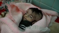 Operasi militer yang dilakukan oleh koalisi pimpinan Arab Saudi itu untuk membantu pemerintah memukul mundur pemberontak dari ibukota, Sanaa, dan sejumlah provinsi lain yang sempat dikuasi pemberontak Houthi. Kondisi itu pun berdampak pada kehidupan masyarakat sipil disana. Kondisi perang yang tak stabil membuat kegiatan ekonomi pun lumpuh sehingga warga kesulitan untuk memperoleh makanan dan membuat sejumlah anak-anak mengalami gizi buruk. Mohamed Al-Sayaghi/Reuters.