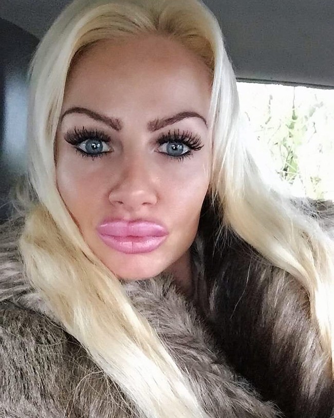 Kerry Miles kaget ketika hasil suntik filler pada bibirnya tidak seperti yang ia inginkan. Alih-alih jadi seksi, bibir wanita 35 tahun ini justru lebih besar dua kali lipat dari ukuran normal. Foto: Instagram/@uk.barbie