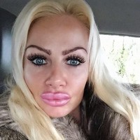 Kerry Miles kaget ketika hasil suntik filler pada bibirnya tidak seperti yang ia inginkan. Alih-alih jadi seksi, bibir wanita 35 tahun ini justru lebih besar dua kali lipat dari ukuran normal. Foto: Instagram/@uk.barbie