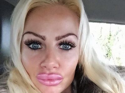 Ngeri! Bibir Wanita Ini Jontor karena Suntik Filler Dicampur Baby Oil