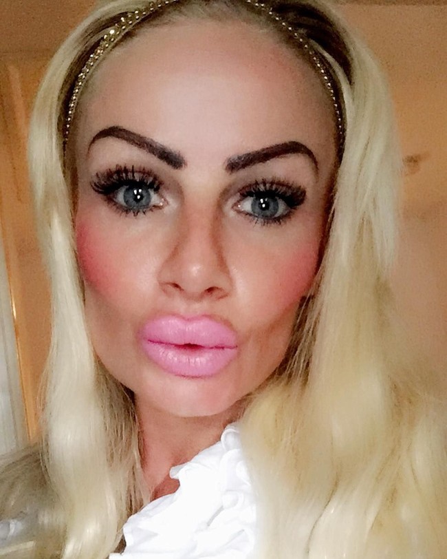 Ibu satu anak ini mengklaim bibirnya memar-memar dan serasa terbakar, satu jam setelah suntik filler. Foto: Instagram/@uk.barbie