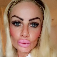 Ibu satu anak ini mengklaim bibirnya memar-memar dan serasa terbakar, satu jam setelah suntik filler. Foto: Instagram/@uk.barbie