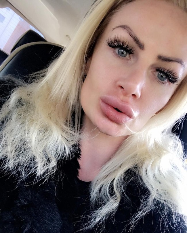 Panik bibirnya jadi tak keruan bentuknya, Kerry memutuskan mengeluarkan cairan filler dari bibirnya ke dokter. Tak disangka, sang dokter mengatakan kalau cairan filler tersebut dicampur dengan baby oil. Foto: Instagram/@uk.barbie