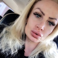 Panik bibirnya jadi tak keruan bentuknya, Kerry memutuskan mengeluarkan cairan filler dari bibirnya ke dokter. Tak disangka, sang dokter mengatakan kalau cairan filler tersebut dicampur dengan baby oil. Foto: Instagram/@uk.barbie