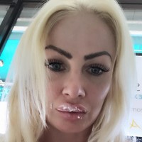 Wanita asal Essex, Inggris, ini suntik filler untuk mempercantik senyumannya. Tapi setelah prosedur selesai dilakukan, bibirnya terlihat seperti daging mentah saking besar dan tebalnya. Foto: Instagram/@uk.barbie