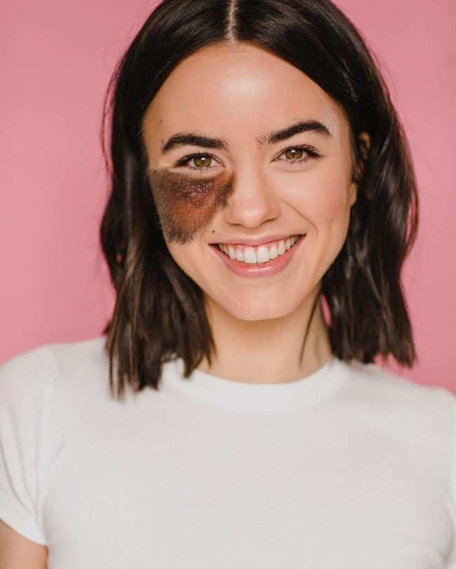 Bisa dilihat Cassandra memiliki tanda lahir berbulu cukup besar di wajahnya. Meski merupakan ketidaksempurnaan, hal tersebut justru membuatnya unik. Foto: Instagram/@cassandranaud