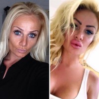 Perlu waktu dua tahun bagi Kerry sampai bibirnya kembali normal pasca suntik filler, yang prosedurnya dilakukan pada 2016 silam. Foto: Instagram/@uk.barbie